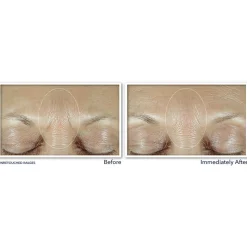 RoC Derm Correxion Fill+ Treat Serum 15 ml